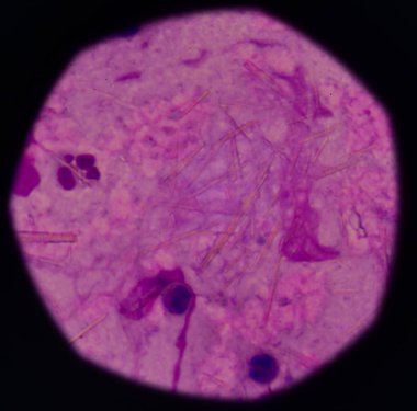 beyaz kan hücreleri Ürik asit kristal iğne şeklinde