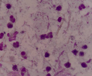 beyaz kan hücreleri Ürik asit kristal iğne şeklinde