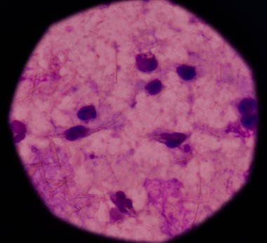 beyaz kan hücreleri Ürik asit kristal iğne şeklinde