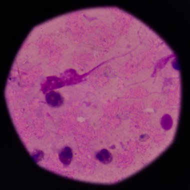 beyaz kan hücreleri Ürik asit kristal iğne şeklinde