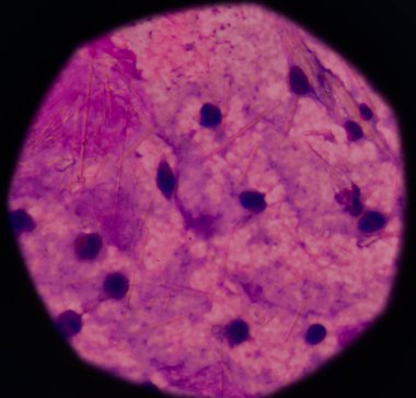 beyaz kan hücreleri Ürik asit kristal iğne şeklinde