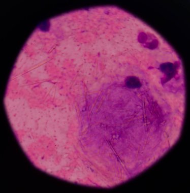 beyaz kan hücreleri Ürik asit kristal iğne şeklinde