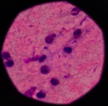 beyaz kan hücreleri Ürik asit kristal iğne şeklinde