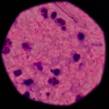 beyaz kan hücreleri Ürik asit kristal iğne şeklinde