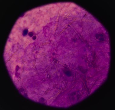 beyaz kan hücreleri Ürik asit kristal iğne şeklinde