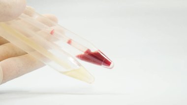 Beyaz üzerine idrar analizi.