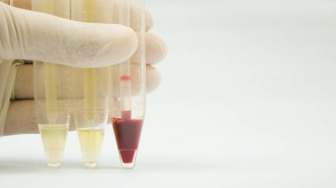 Beyaz üzerine idrar analizi.