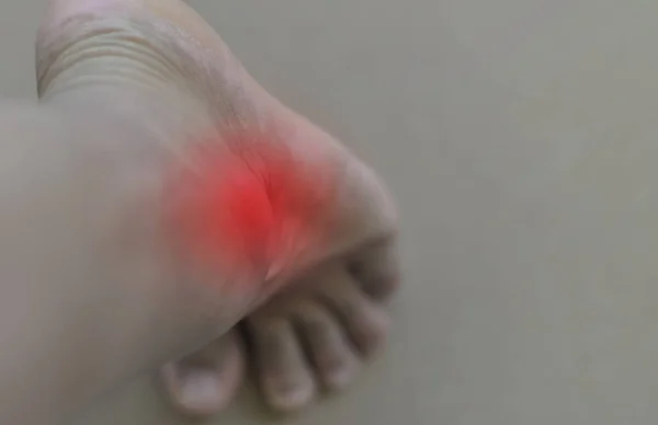 Painful and inflamed gout — Stock Photo, Image