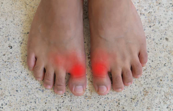 Painful and inflamed gout — Stock Photo, Image