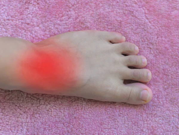 Painful and inflamed gout — Stock Photo, Image