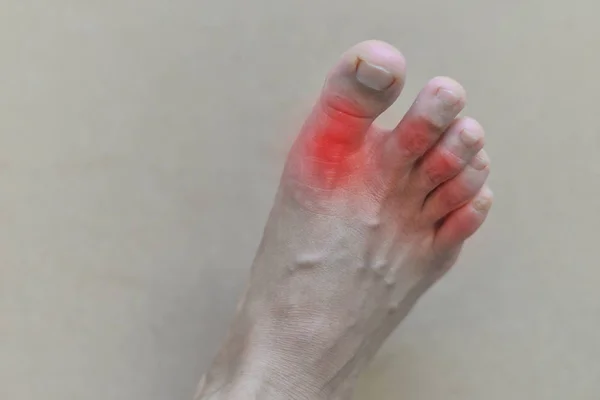 Painful and inflamed gout — Stock Photo, Image