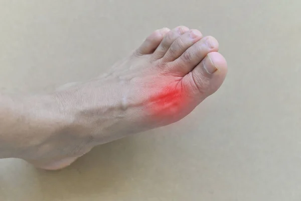 Painful and inflamed gout — Stock Photo, Image