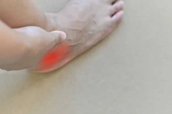 Painful and inflamed gout — Stock Photo, Image