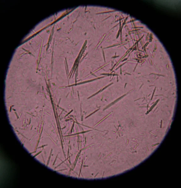 Acide urique modéré forme d'aiguille en cristal — Photo