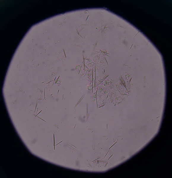 Matige urinezuur kristallen naald vorm — Stockfoto
