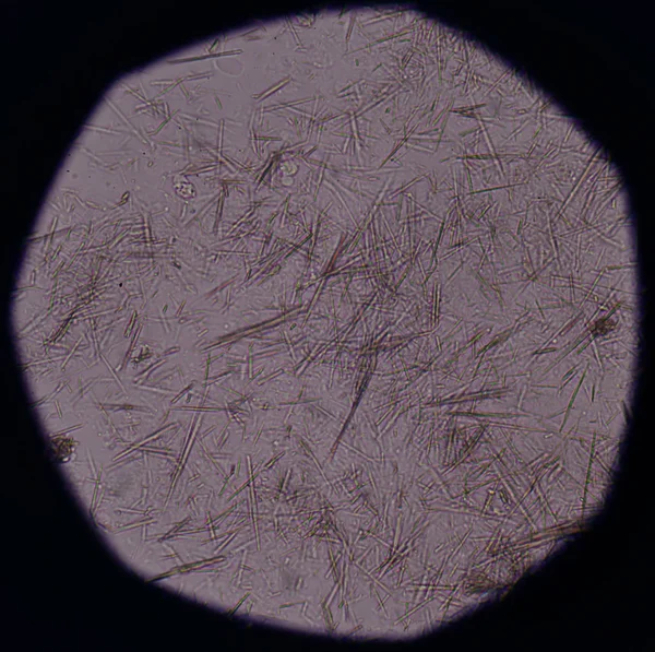 Moderate Uric acid crystal needle shape