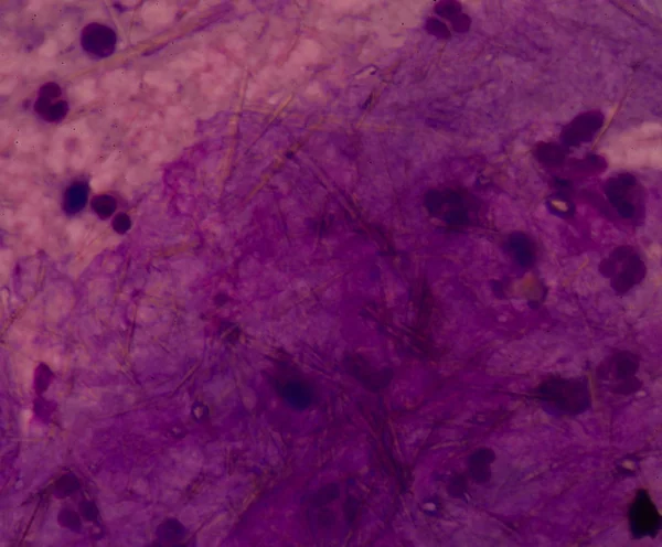 Glóbulos brancos com forma de agulha de cristal de ácido úrico — Fotografia de Stock