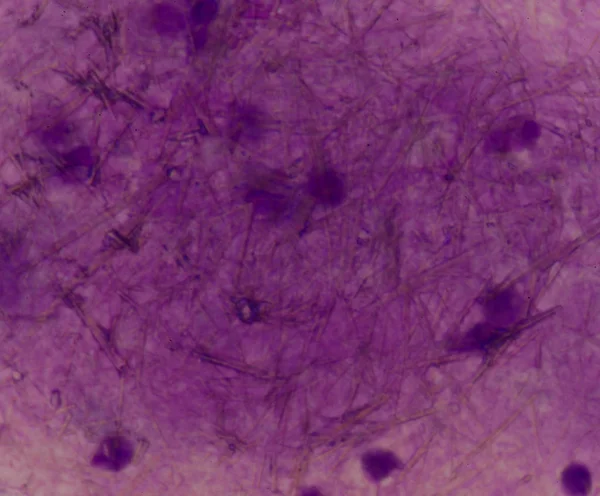 beyaz kan hücreleri Ürik asit kristal iğne şeklinde