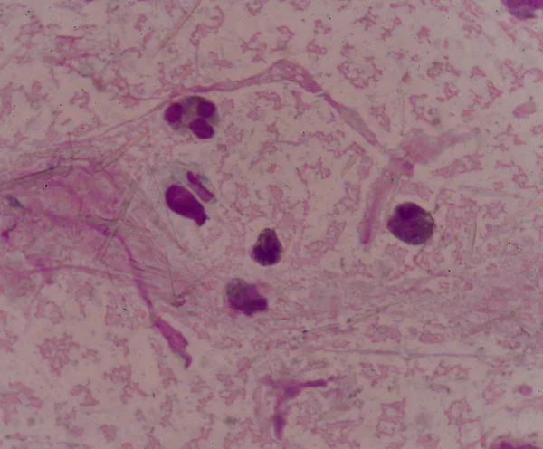 White blood cells with Uric acid crystal needle shape — Stock Photo, Image