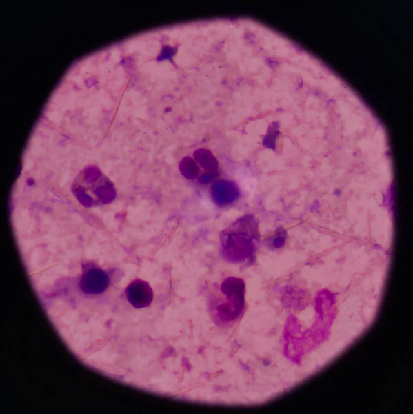 Weiße Blutkörperchen mit Harnsäure-Kristallnadelform — Stockfoto