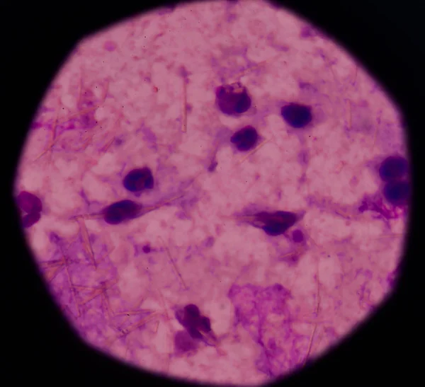 Weiße Blutkörperchen mit Harnsäure-Kristallnadelform — Stockfoto