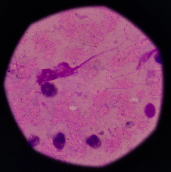 beyaz kan hücreleri Ürik asit kristal iğne şeklinde