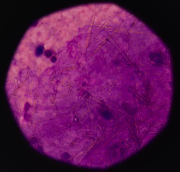 beyaz kan hücreleri Ürik asit kristal iğne şeklinde