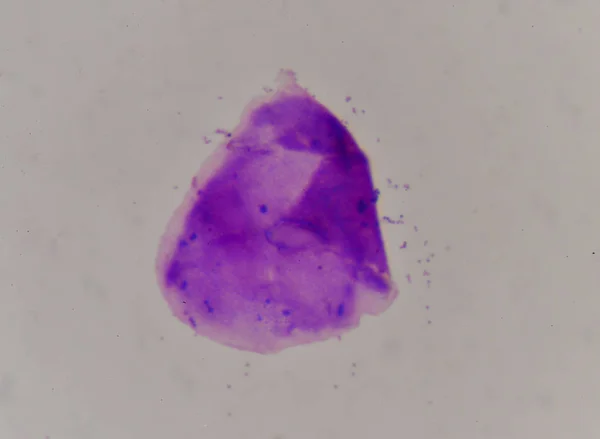 Hallazgo de células sanguíneas con microscopio . — Foto de Stock