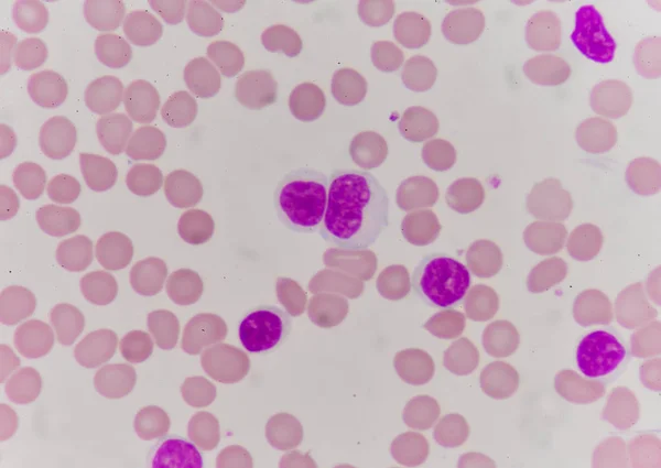 Blood cells finding with microscope. — Stock Photo, Image