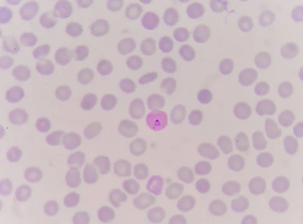 Close-up van rode bloedcellen malaria pigment. — Stockfoto