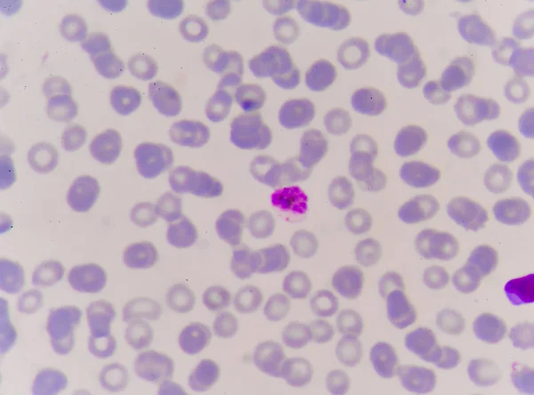 Close up red blood cells malaria pigment. — Stock Photo, Image