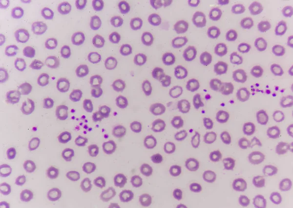 Thrombocyta megszilárduló, mint egy lehetséges oka az alacsony vérlemezke szám, p — Stock Fotó