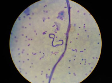 microfilaria tissue parasite infection to human. clipart