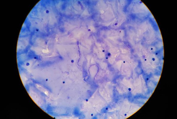 microfilaria tissue parasite infection to human.