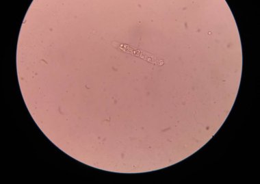 beyaz kan hücreleri idrarda döküm.