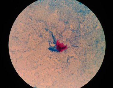 Asit hızlı basiller olumlu kırmızı hücreleri.