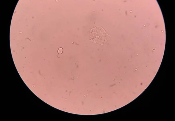 Komórki nabłonka w osadzie moczu z bliska. — Zdjęcie stockowe