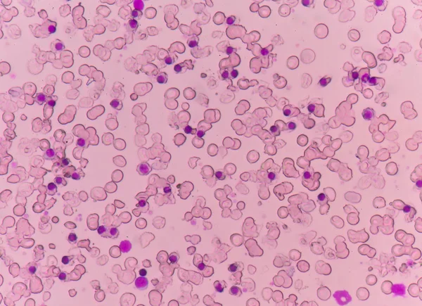 Blood smear Thalassemia patient. — Stock Photo, Image