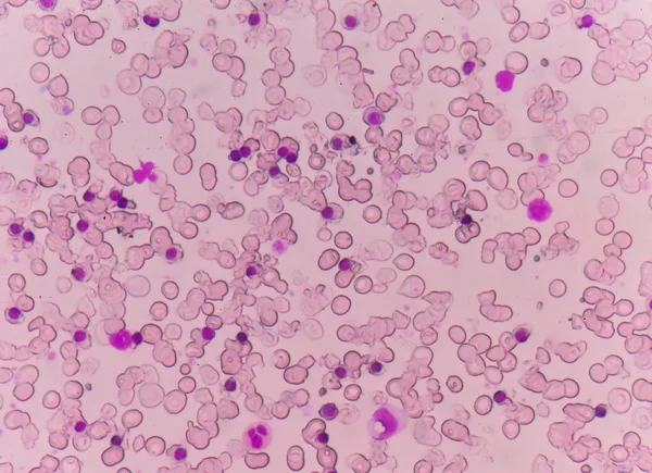 Frotis de sangre Paciente con talasemia . —  Fotos de Stock