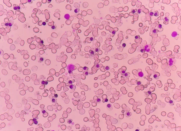 Blood smear Thalassemia patient. — Stock Photo, Image