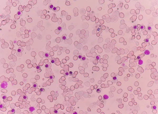 Krevní roztěr thalasémií pacienta. — Stock fotografie