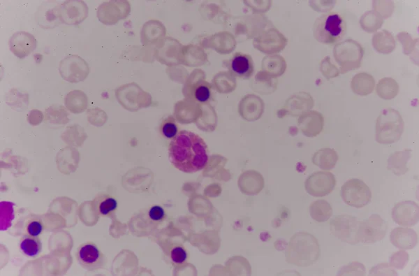 Spalmare il sangue paziente talassemia . — Foto Stock