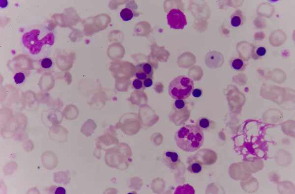 Spalmare il sangue paziente talassemia . — Foto Stock