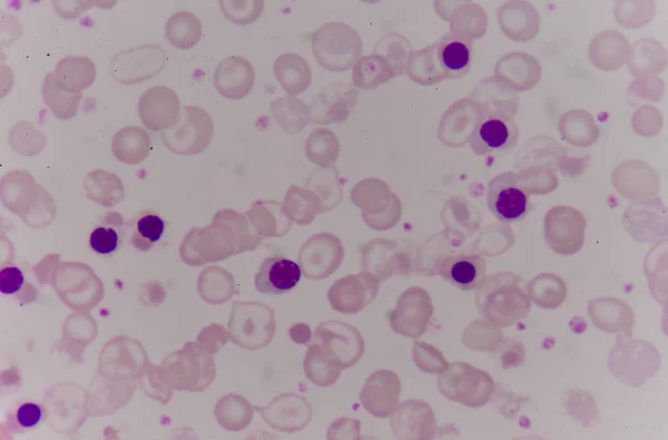 Blood smear Thalassemia patient. — Stock Photo, Image