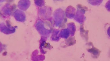 Anormal kan hücre arka planı.