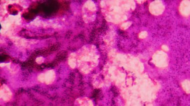 Anormal kan hücre arka planı.