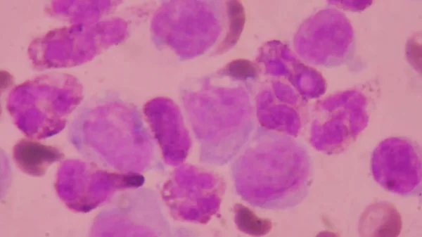 Abnormální krevní buňky pozadí. — Stock fotografie