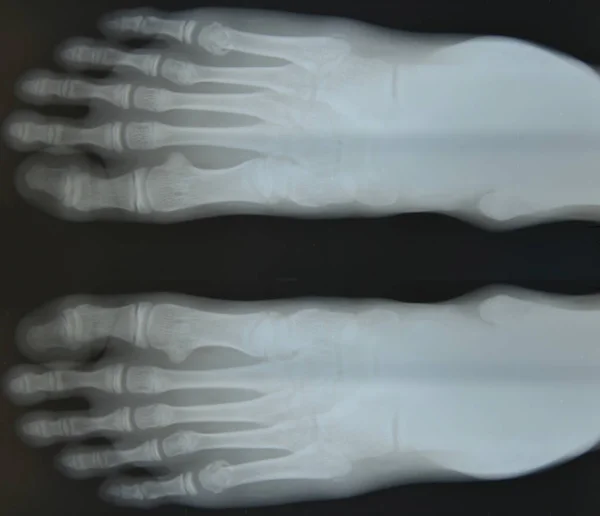 Των οστών του πόδι φιλμ ακτίνων χ. — Φωτογραφία Αρχείου