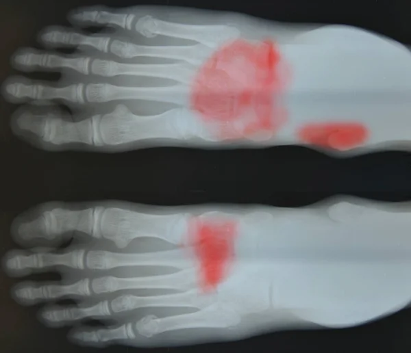 Kości stopy x-ray film. — Zdjęcie stockowe