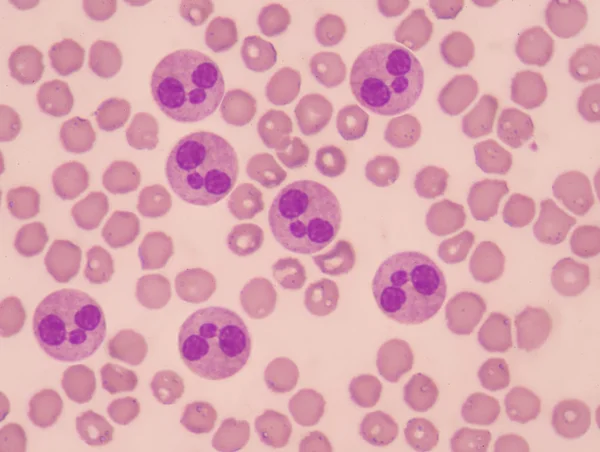 Neutrophil mit roten Blutkörperchen. — Stockfoto